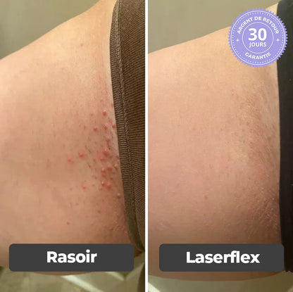 Épilateur Indolore 2 en 1 - Laserflex
